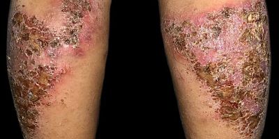 Hatay’da açıklanan bir vaka yok ama…