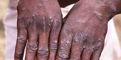 Ölü sayısı 500’ü aştı! DSÖ ‘maymun çiçeği virüsü’ için acil toplandı